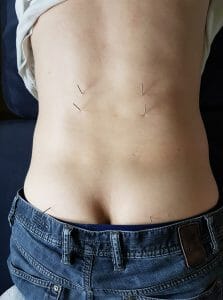 Akupunktur mod spinalstenose i lænden