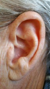 Tinnitus kan behandles effektivt hos Boel Akupunktur